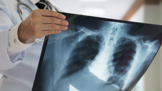 В Акмолинской области за 10 лет заболеваемость туберкулёзом снизилась в 2,7 раза