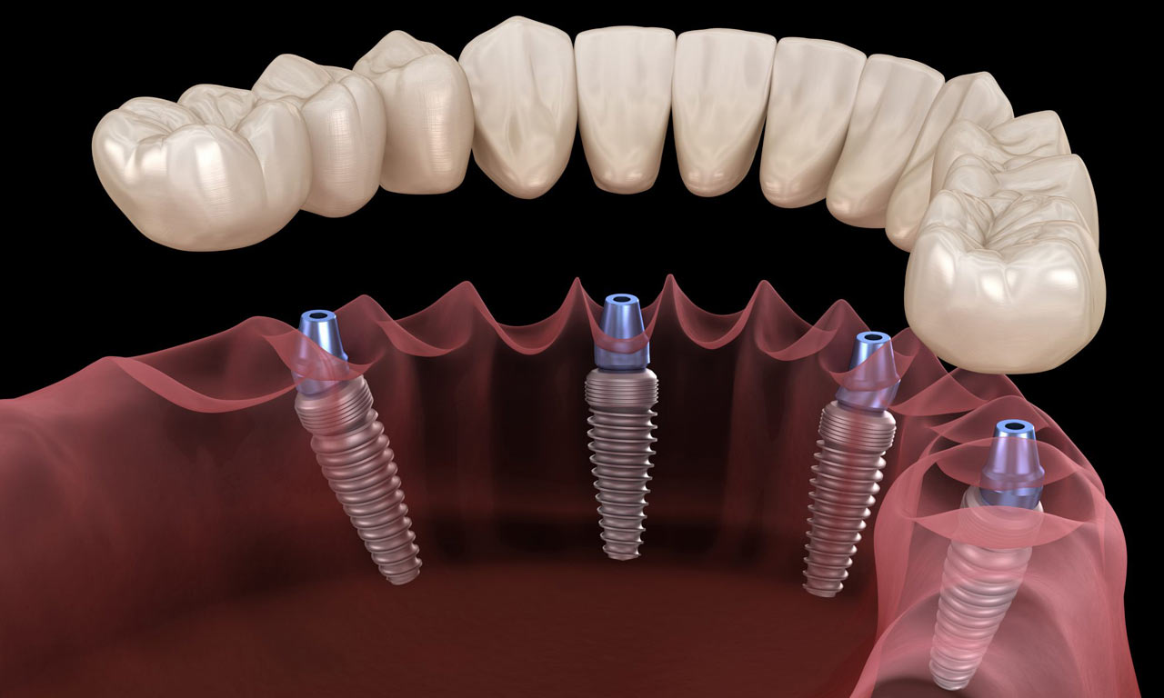 Имплантация зубов - что это, противопоказания, осложнения, сравнение с протезированием