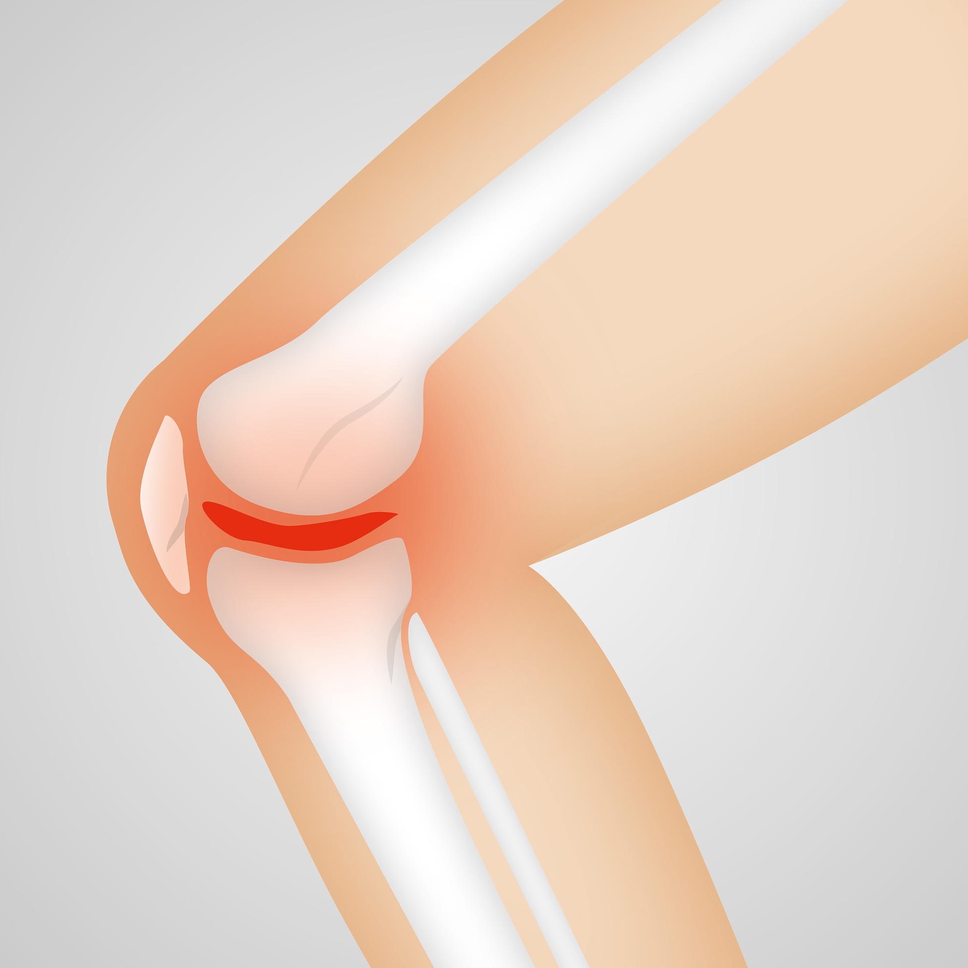 Артрит коленного сустава: причины возникновения, упражнения, гимнастика и прочее лечение